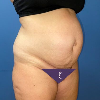 Tummy Tuck Before & After