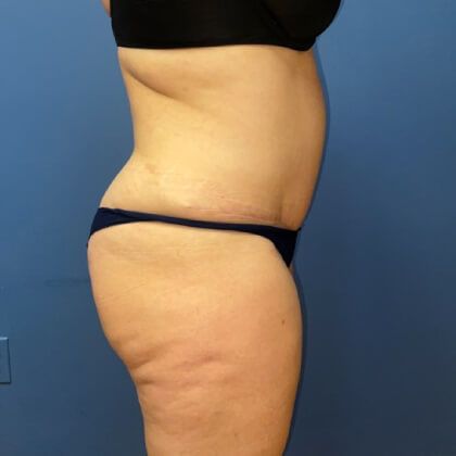 Tummy Tuck Before & After