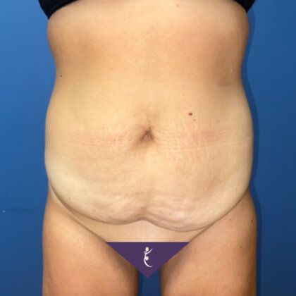 Tummy Tuck Before & After