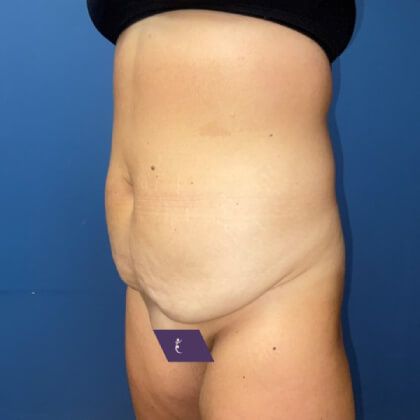 Tummy Tuck Before & After