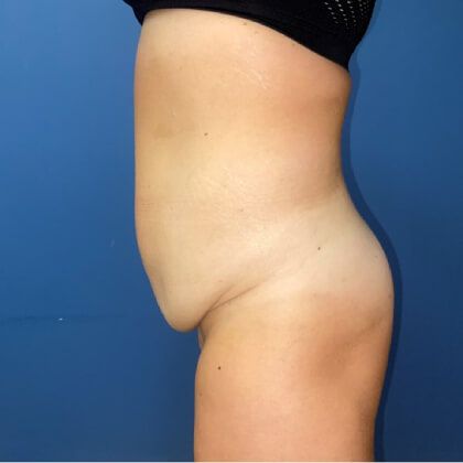 Tummy Tuck Before & After