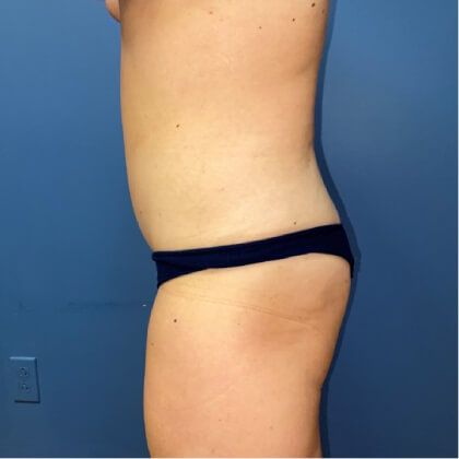 Tummy Tuck Before & After