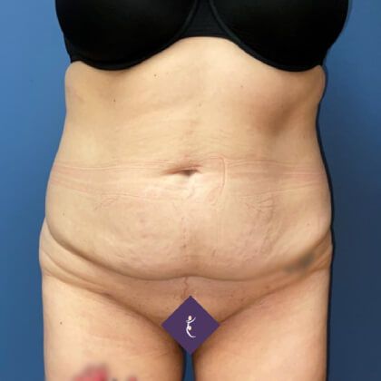 Tummy Tuck Before & After