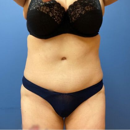 Tummy Tuck Before & After