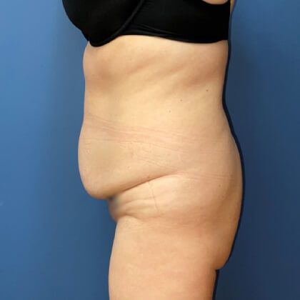 Tummy Tuck Before & After