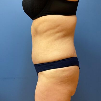Tummy Tuck Before & After