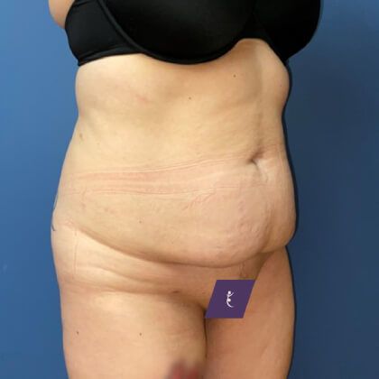 Tummy Tuck Before & After