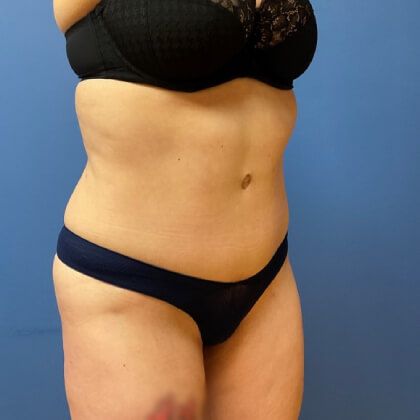 Tummy Tuck Before & After