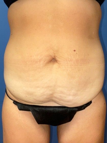 Tummy Tuck Before & After