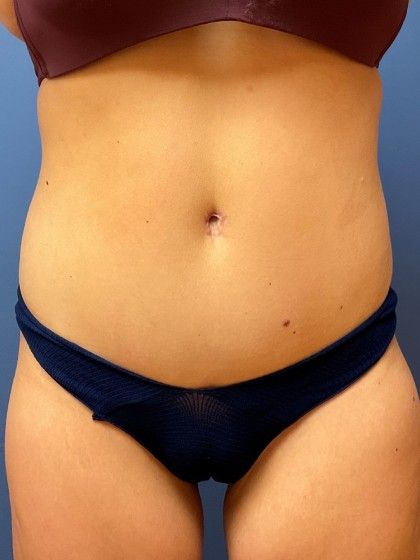 Tummy Tuck Before & After