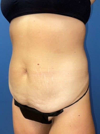 Tummy Tuck Before & After