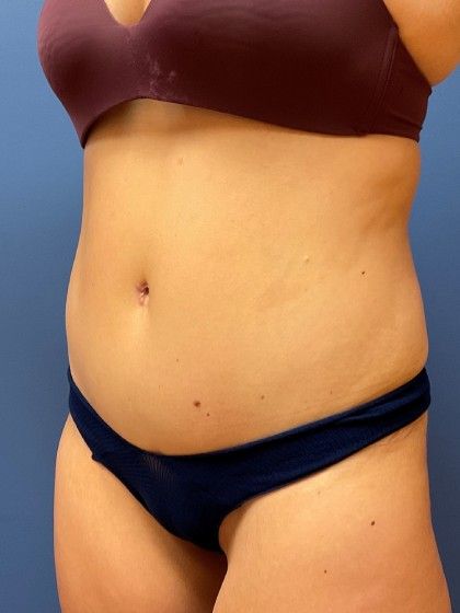 Tummy Tuck Before & After