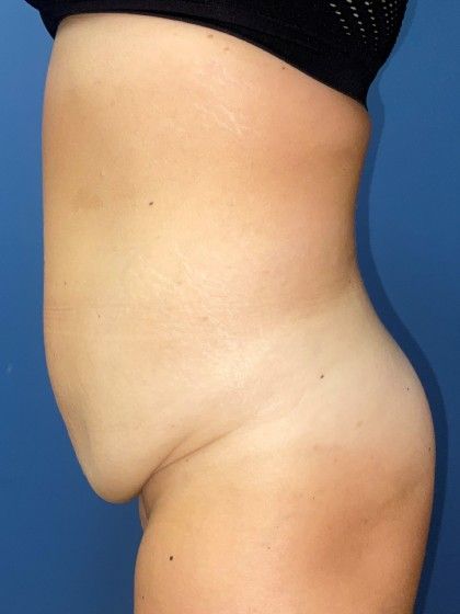 Tummy Tuck Before & After