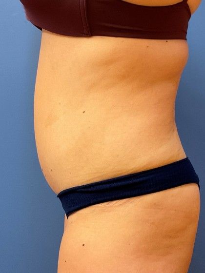 Tummy Tuck Before & After