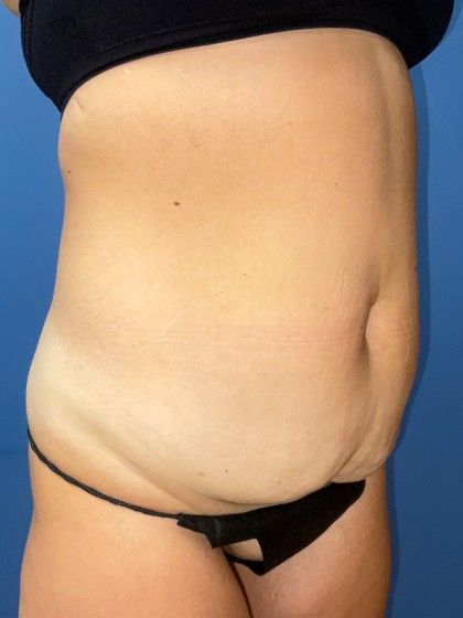 Tummy Tuck Before & After