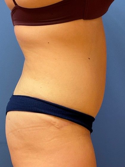 Tummy Tuck Before & After