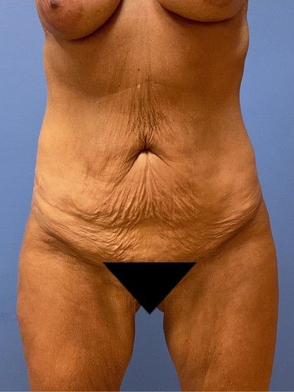Tummy Tuck Before & After