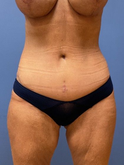 Tummy Tuck Before & After