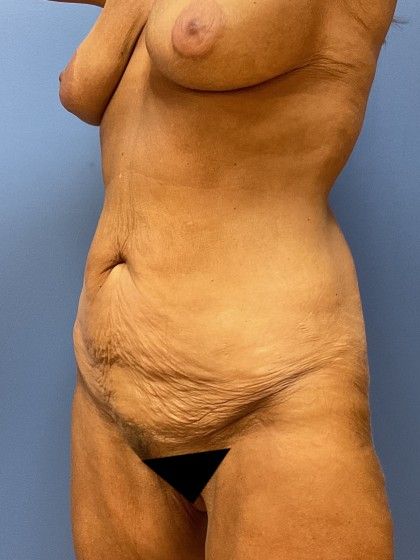 Tummy Tuck Before & After