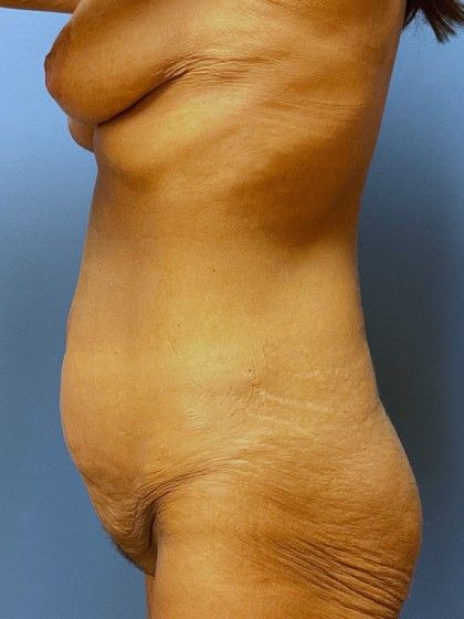 Tummy Tuck Before & After