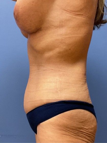 Tummy Tuck Before & After