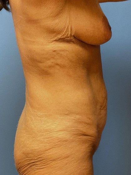 Tummy Tuck Before & After