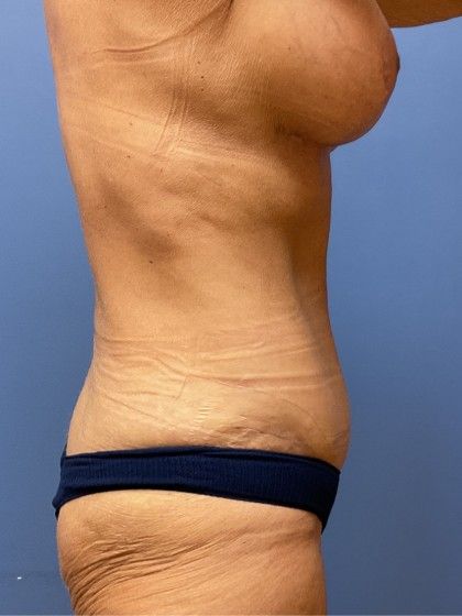 Tummy Tuck Before & After