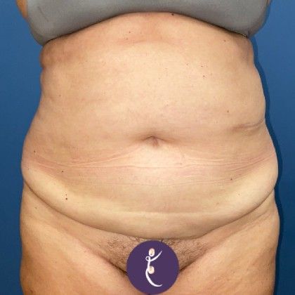 Tummy Tuck Before & After