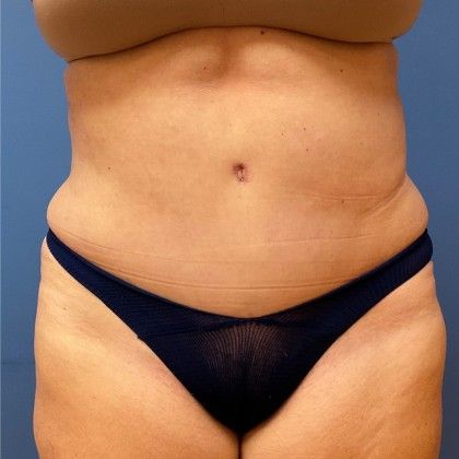 Tummy Tuck Before & After