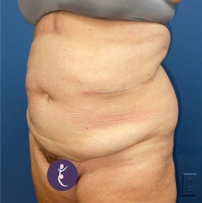 Tummy Tuck Before & After