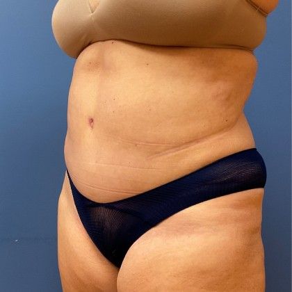 Tummy Tuck Before & After