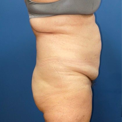 Tummy Tuck Before & After