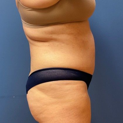 Tummy Tuck Before & After