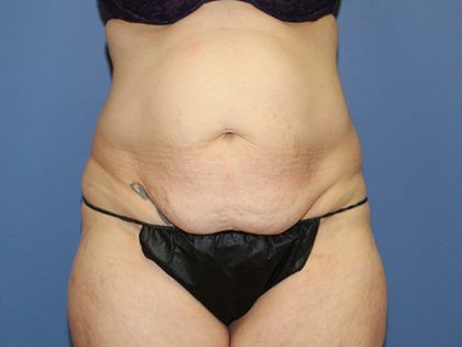Tummy Tuck Before & After