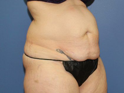 Tummy Tuck Before & After