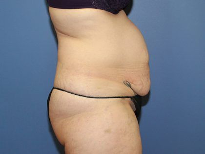 Tummy Tuck Before & After