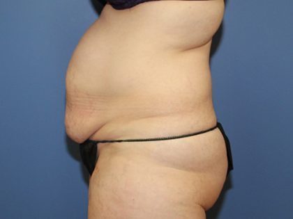 Tummy Tuck Before & After