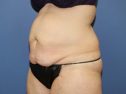 Tummy Tuck Before & After