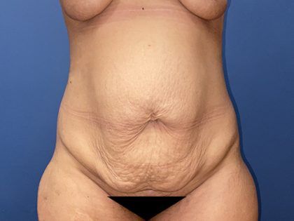Tummy Tuck Before & After