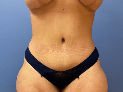 Tummy Tuck Before & After