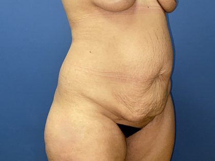 Tummy Tuck Before & After