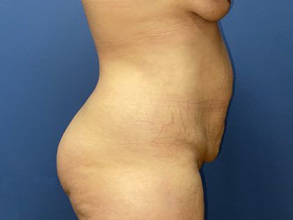 Tummy Tuck Before & After
