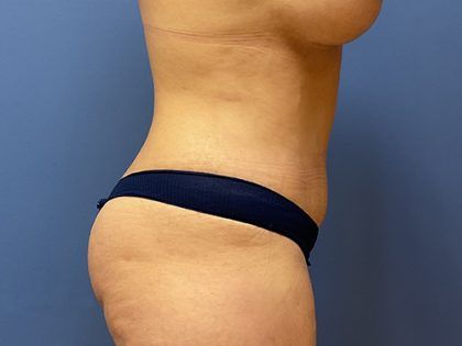 Tummy Tuck Before & After