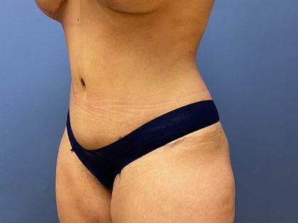 Tummy Tuck Before & After