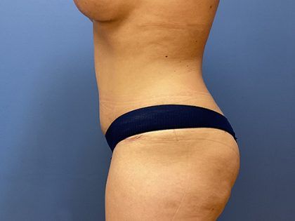 Tummy Tuck Before & After