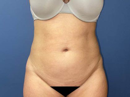 Tummy Tuck Before & After