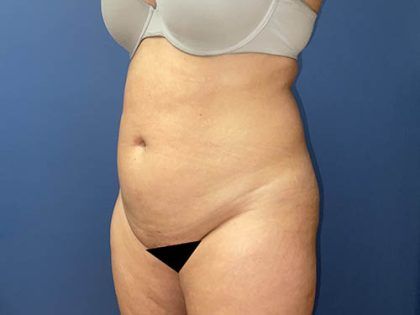 Tummy Tuck Before & After