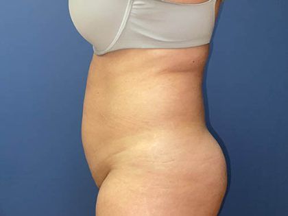 Tummy Tuck Before & After