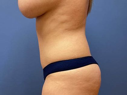 Tummy Tuck Before & After