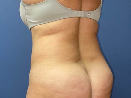 Tummy Tuck Before & After
